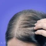 عوامل تشدید کننده ریزش مو